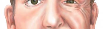Parálisis Facial Periférica: Tratamiento mediante la Fisioterapia - FisioClinics la Moraleja