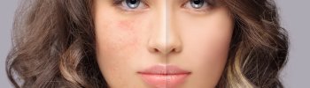 Radiofrecuencia Facial: El Tratamiento No Invasivo para Reducir Arrugas y Reafirmar la Piel
