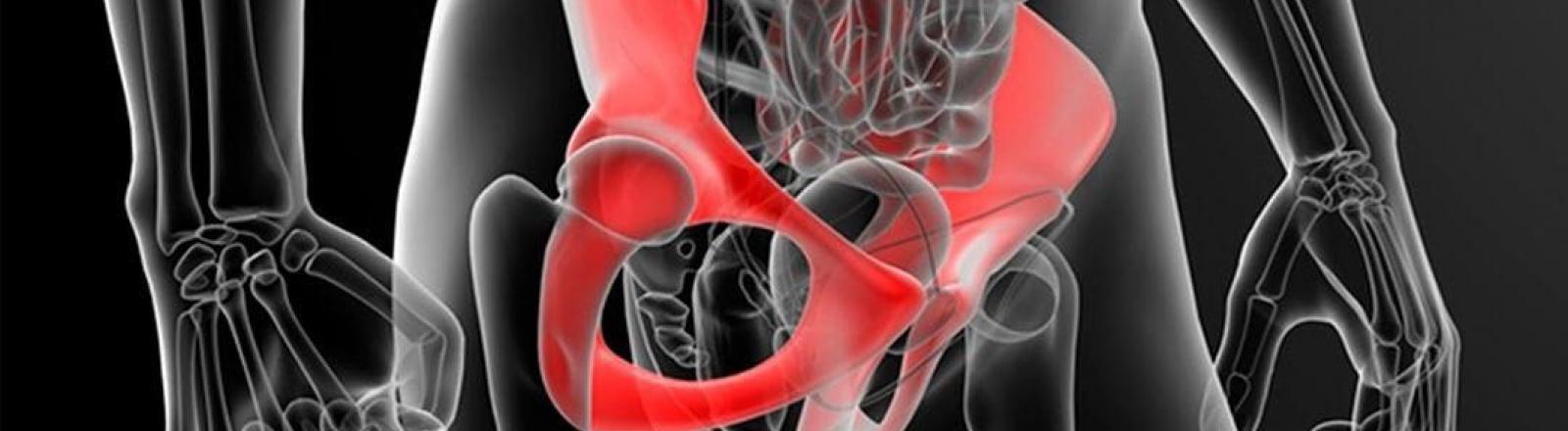osteopatia de pubis o pubalgia osteopatía de pubis o pubalgia