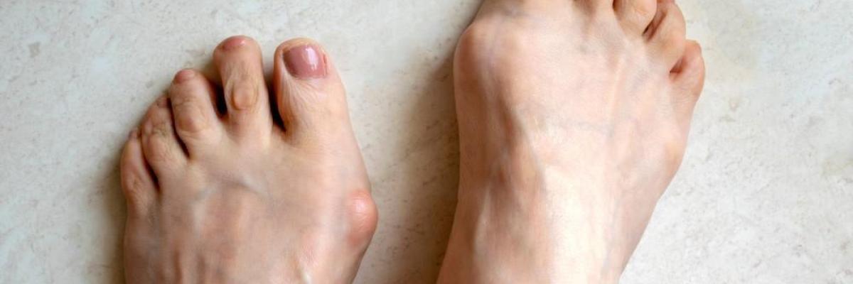 Fisioterapia para hallux rigidus: movilidad y alivio del dolor