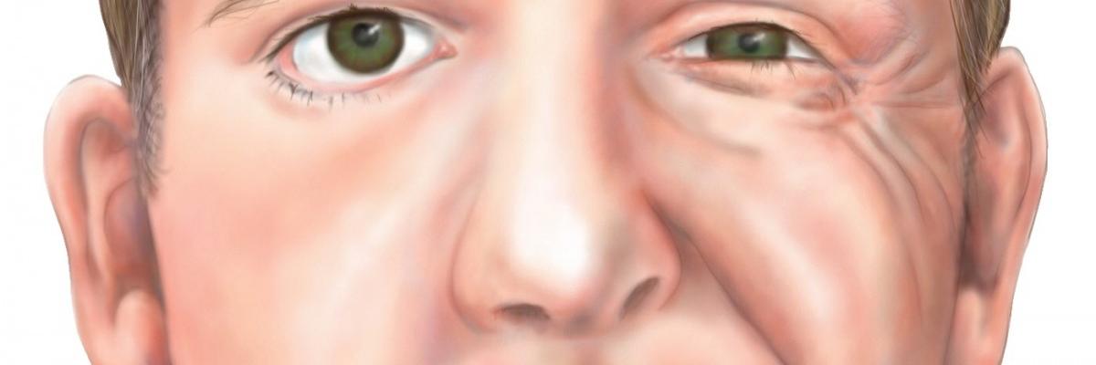 Que masajes puedo hacer online para la paralisis facial