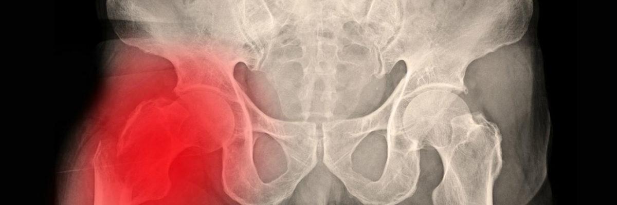 Cómo mejorar la movilidad tras una fractura de cadera con fisioterapia en casa