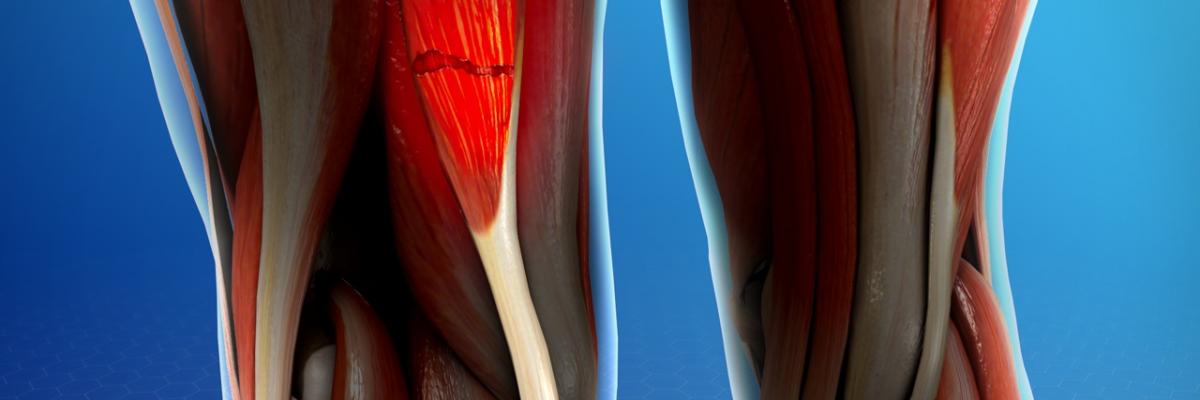 ¿Cómo prevenir una lesión en los isquiotibiales? - FisioClinics la Moraleja