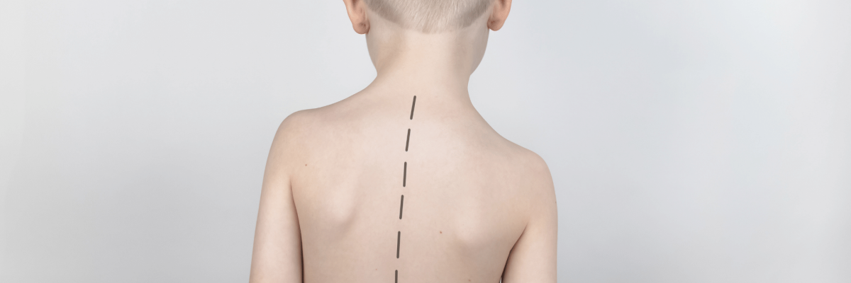 Escoliosis en niños y adolescentes: cómo detectarla y qué ejercicios pueden ayudar