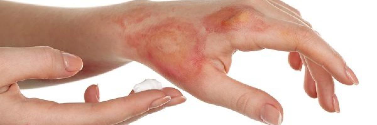 Intervención mediante Fisioterapia para Pacientes Quemados- FisioClinics La Moraleja