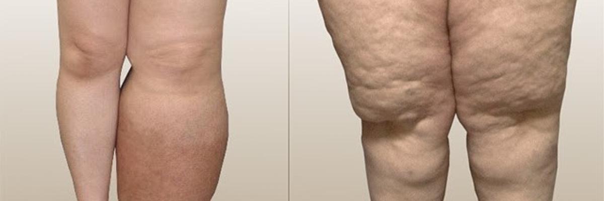 Abordaje fisioterapéutico para las patologías del sistema linfático - FisioClinics La Moraleja 