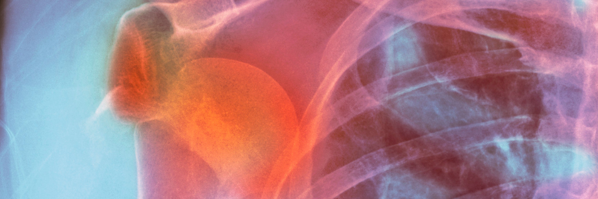 Tratamientos conservadores para la lesión del manguito rotador sin cirugía