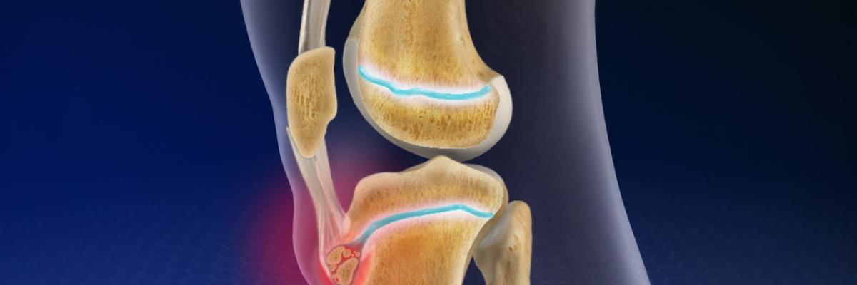 Enfermedad de Osgood - Schlatter y su tratamiento a través de las Ondas de Choque - FisioClinics la Moraleja
