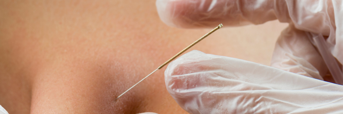 Casos Clínicos Exitosos con Punción Seca: Ejemplos Prácticos de su Aplicación