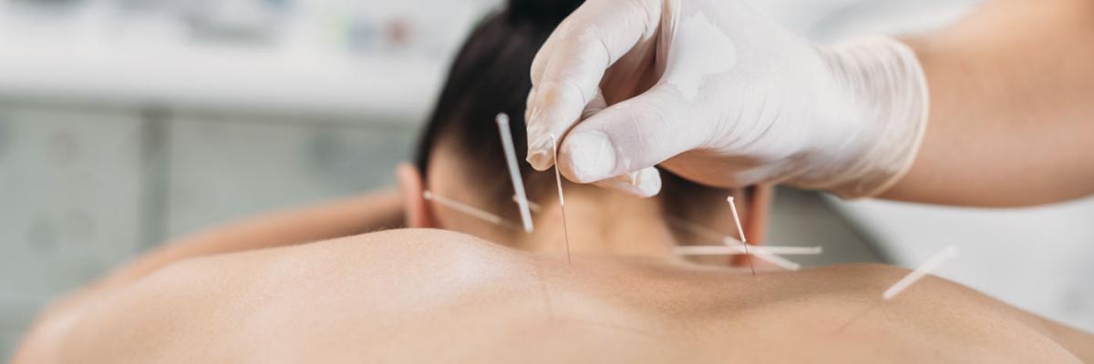 Punción Seca en la Fisioterapia del Dolor Crónico: Mejora de la Calidad de Vida a Largo Plazo